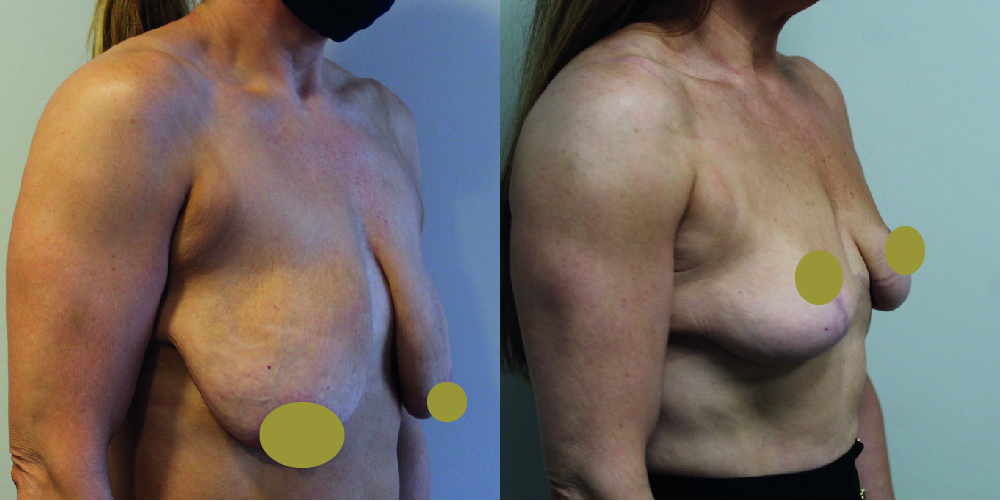 Mastopexy Before & After Image