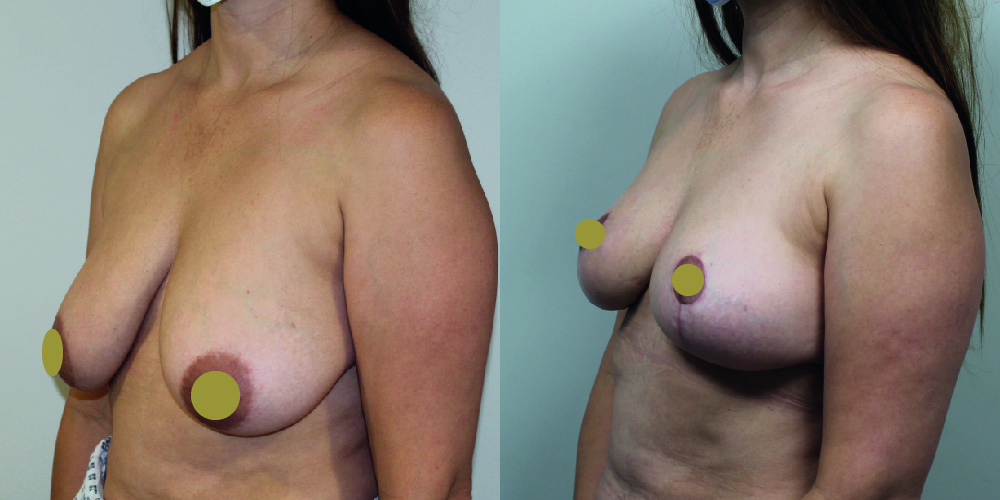 Mastopexy Before & After Image