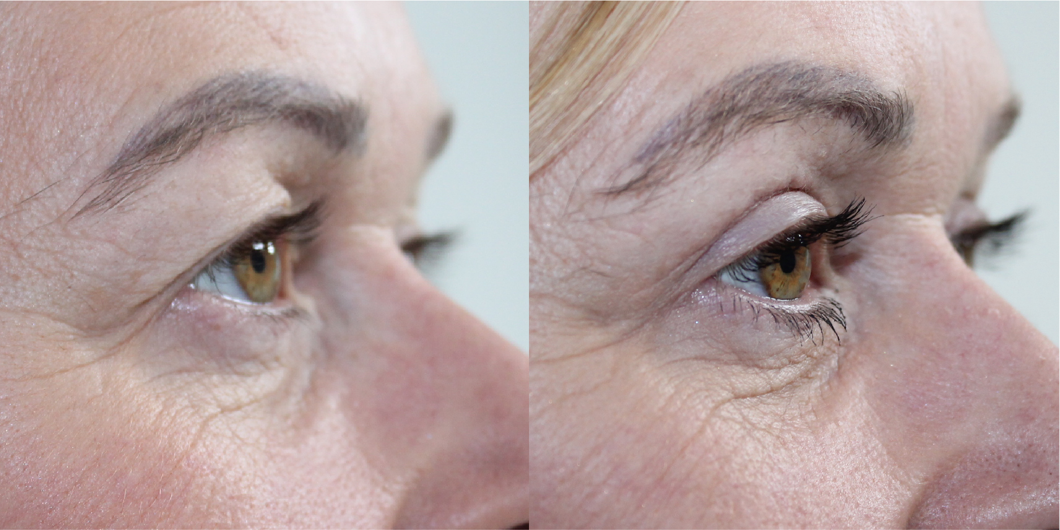 Blepharoplasty Before & After Image