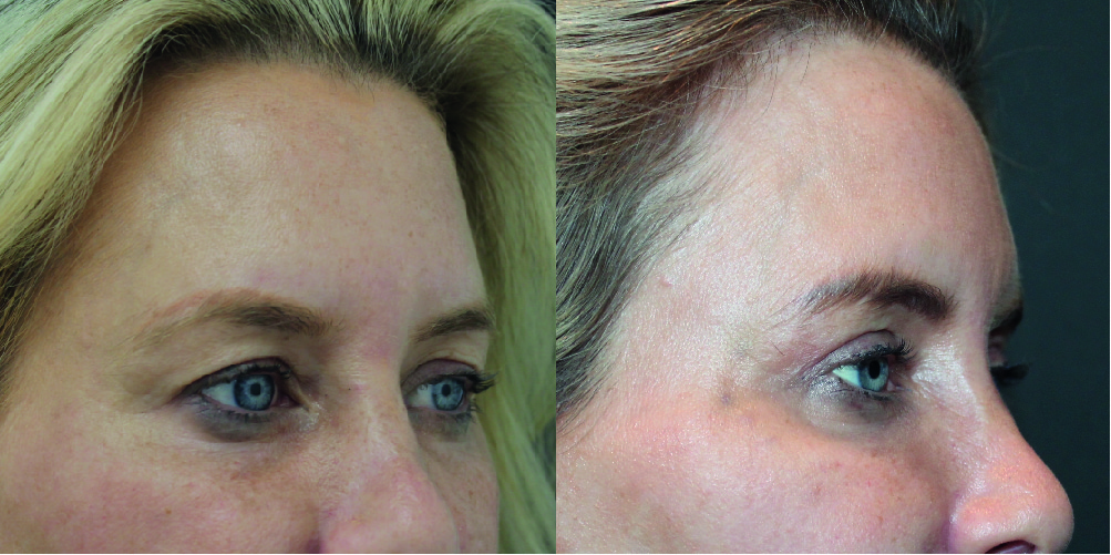 Blepharoplasty Before & After Image