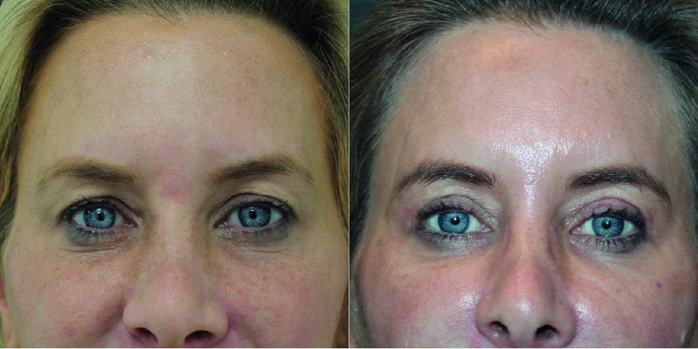 Blepharoplasty Before & After Image