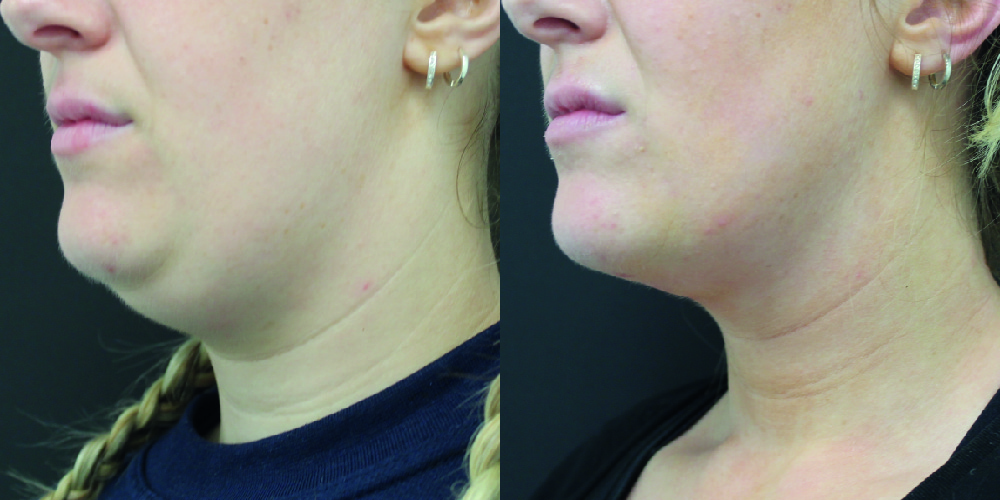 Double Chin Liposuction Before & After Image