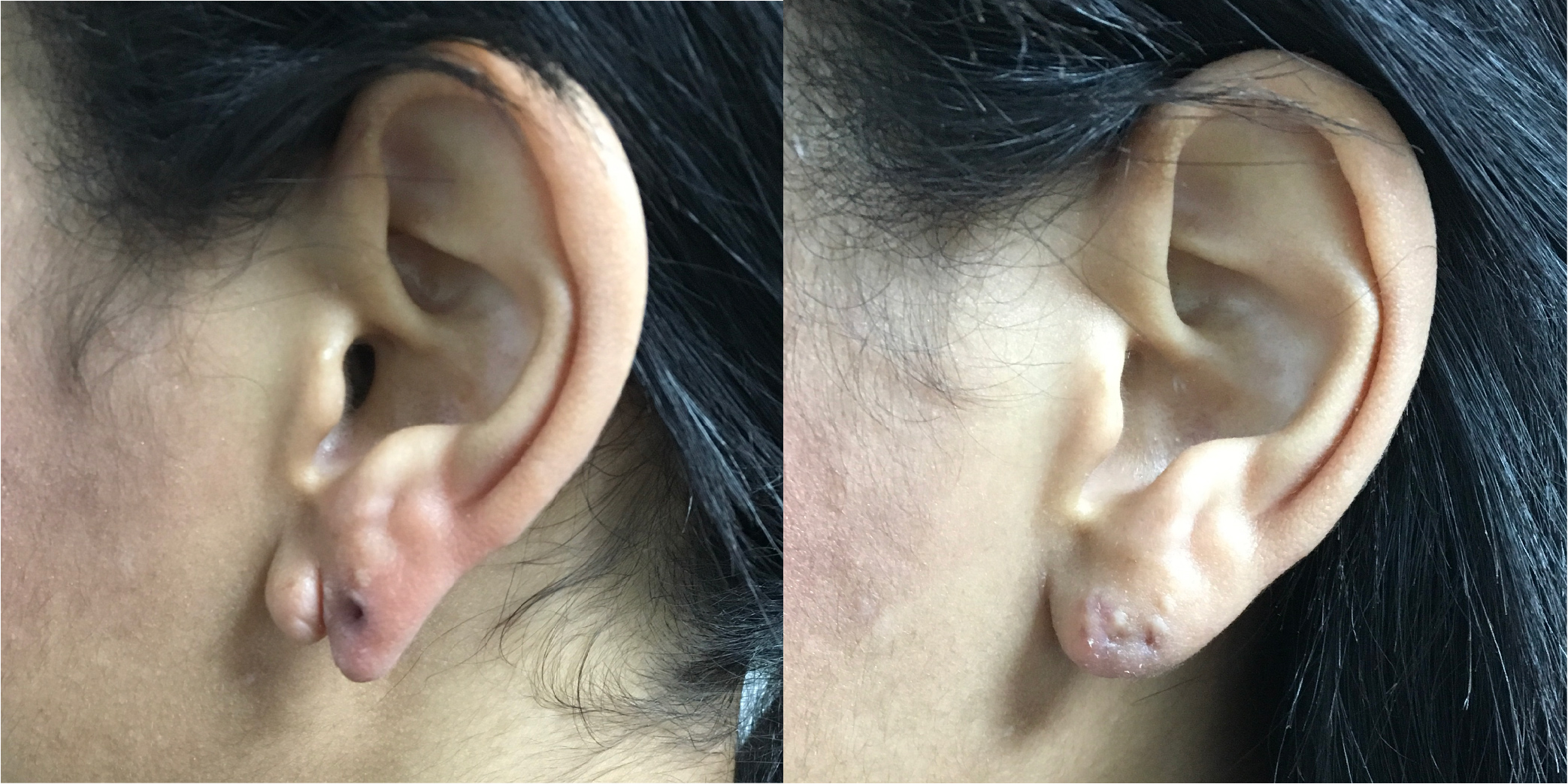 Earlobe Repair Before & After Image