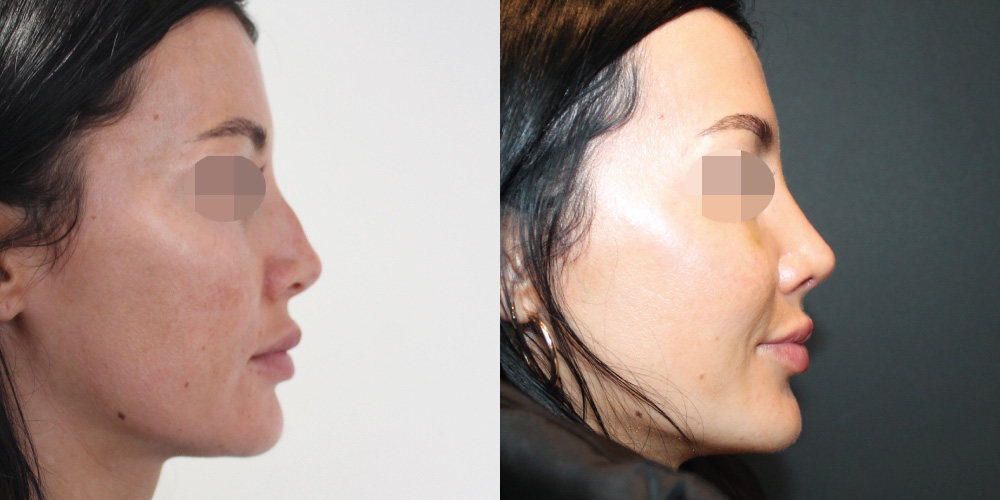 Rhinoplasty Before & After Image