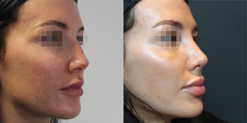 Rhinoplasty Before & After Image