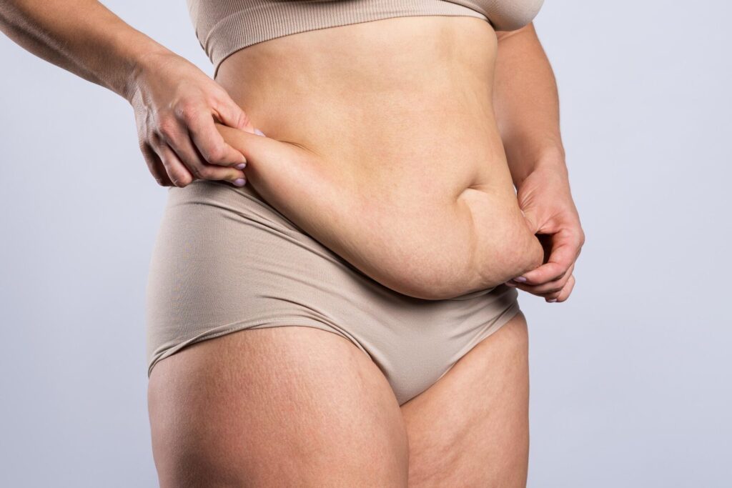 What is an Apron Belly and How Can You Get Rid of It?