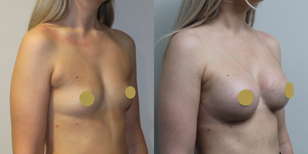 boob job before and after 300 high profile tear drop implants