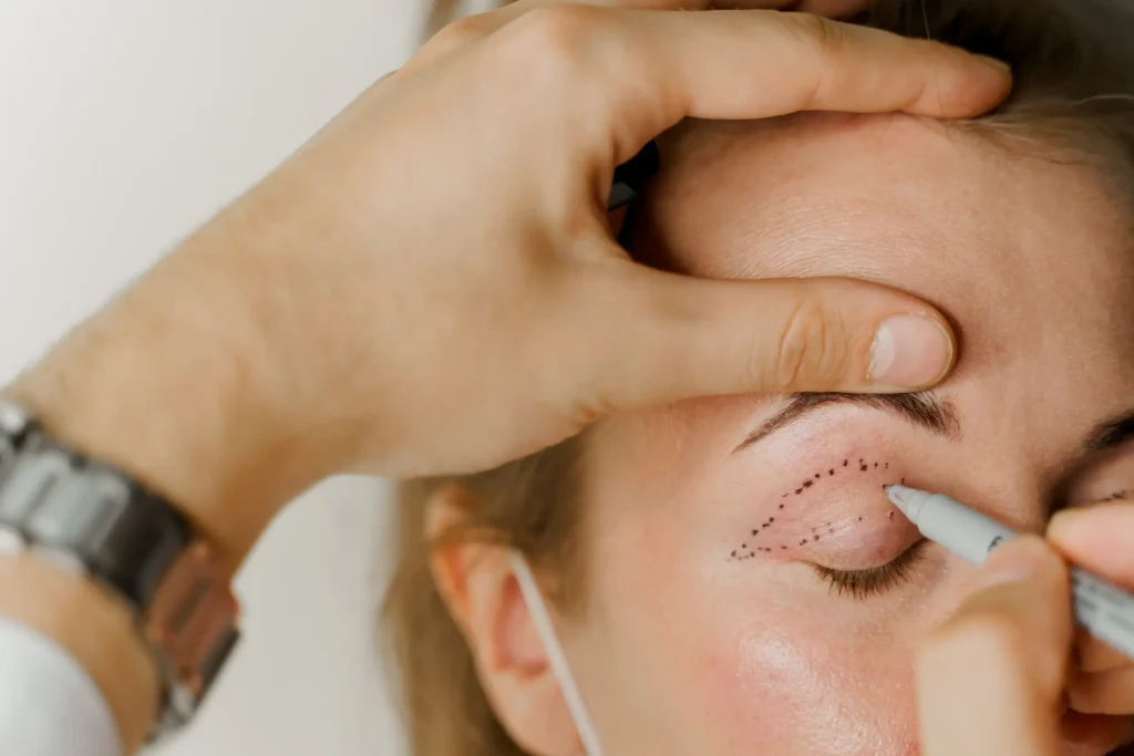 How much is the Cost of Blepharoplasty in the UK