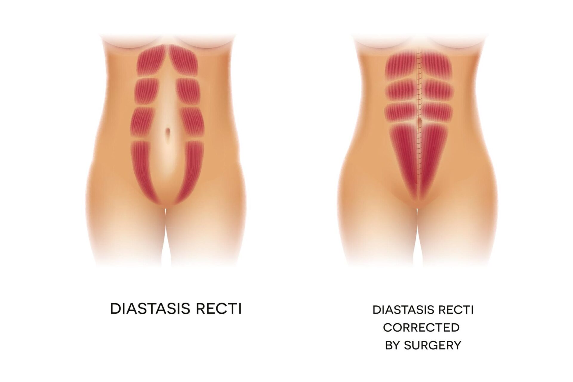 what-is-diastasis-recti-surgery-reza-nassab-site