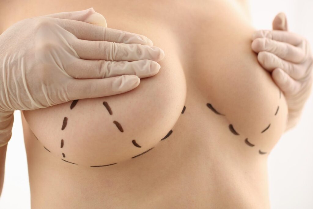 How to Reduce Breast Size
