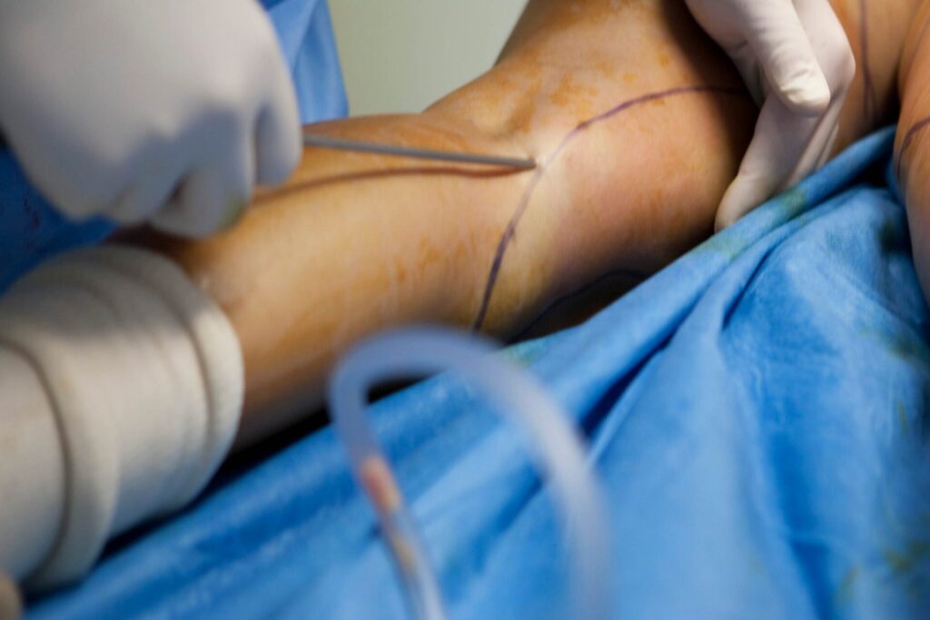 How Much Does Liposuction Cost in the UK?