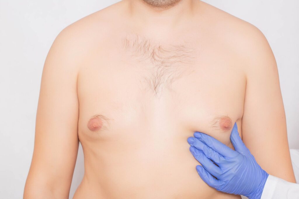 What Are Moobs or Man Boobs?