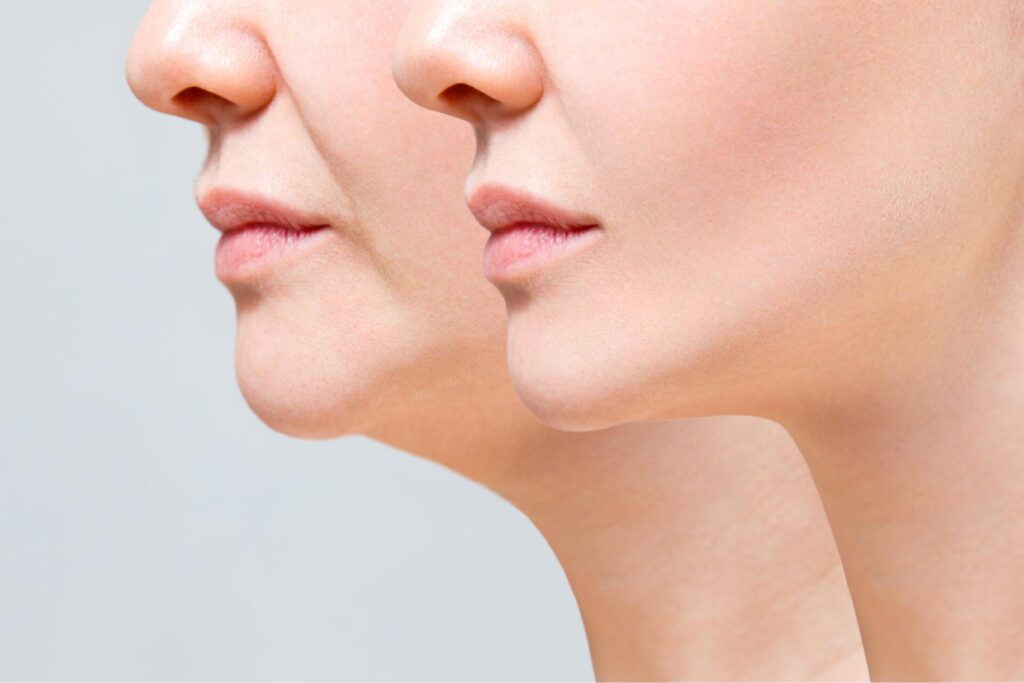 What is the Best Age for a Facelift and Mini Facelift?