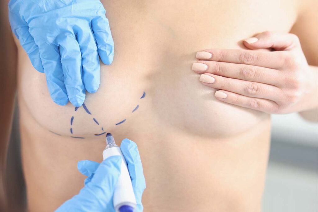 What Is an Autoaugmentation Breast Lift?