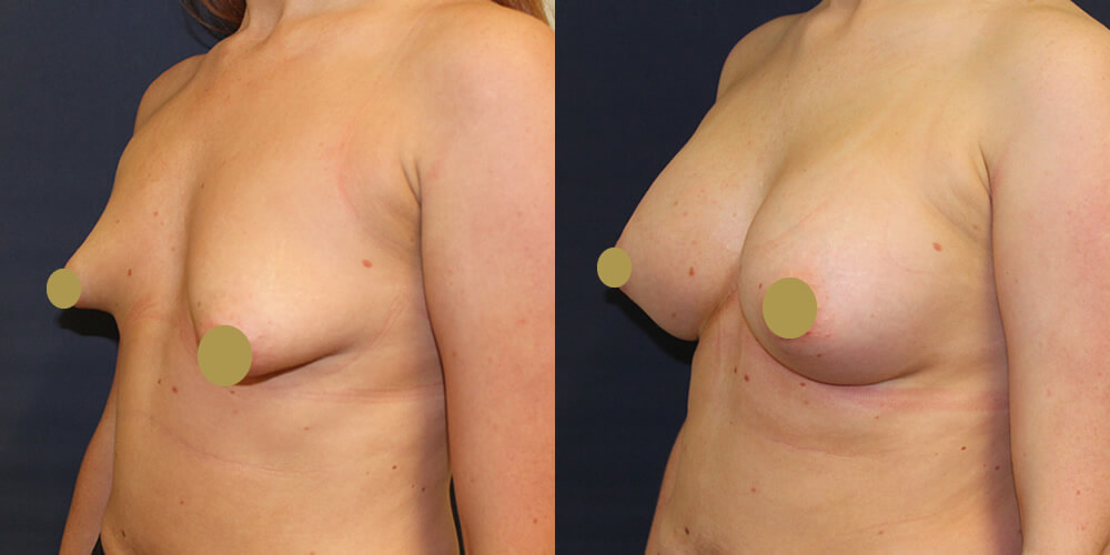 Before and after images showcasing the results of breast augmentation surgery, highlighting enhanced breast shape and size.
