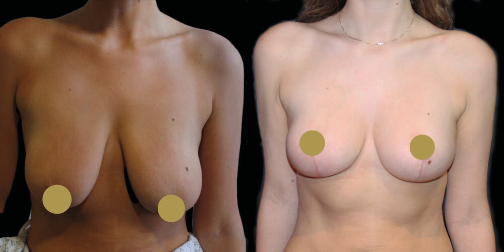 autoaugmentation breast lift before and after 