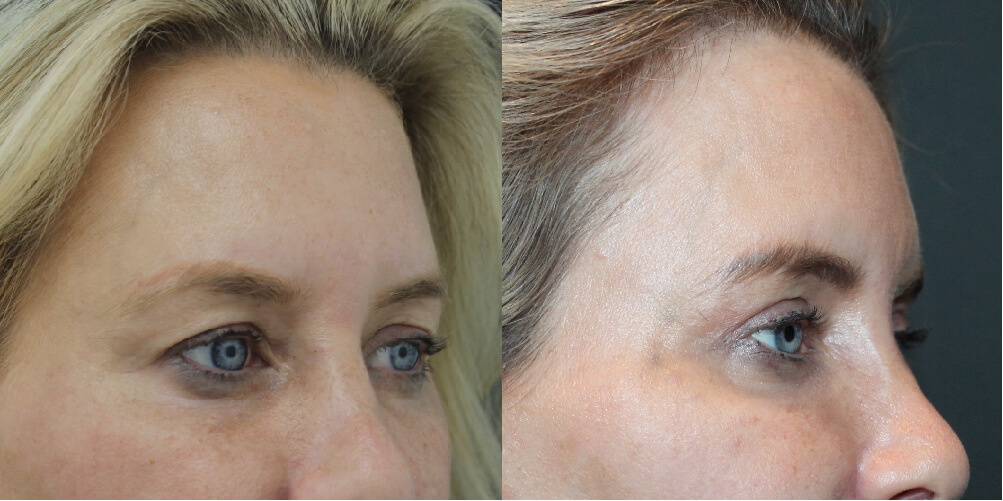 Upper blepharoplasty result — Mr Nassab Manchester