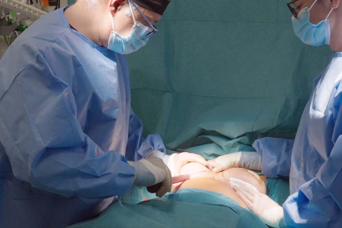 awake breast augmentation