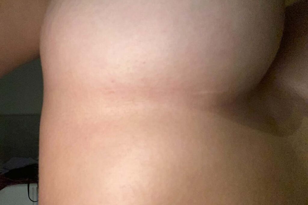 scar after breast augmentation surgery