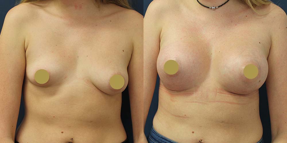 breast asymmetry correction with implants in Manchester